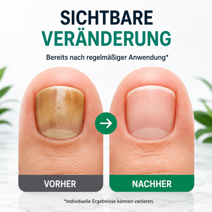 Anti-Pilz Pflegestift für schöne, gesund aussehende Nägel
